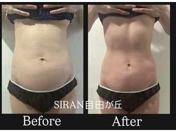 シラン(Siran)/Wラジオ波＋吸引でサイズダウン