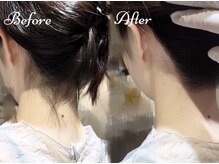 ピミル(PIMIL)/うなじ脱毛