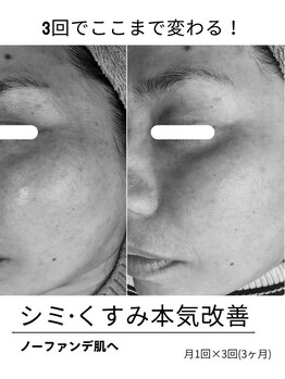 エイチケービューティーサロン(H/K beauty salon)/【シミ・くすみ】