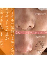 サロン 半田店(SALON)/毛穴エクストラクション