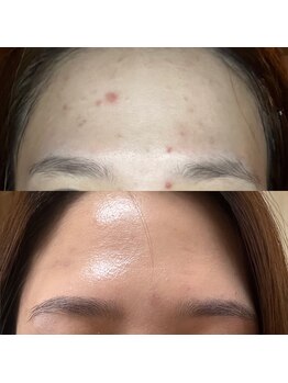 アノネ(Anone.)/ハーブピーリングBbefore After