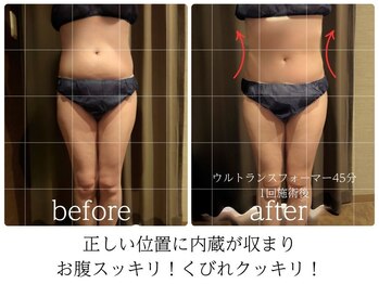 ライフチャージ(Life Charge)/筋膜リリースBefore→After