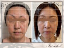 トーティシェル(tortoise shell)/リフトアップにおすすめ