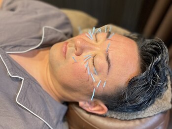 鍼灸院 満月/メンズ美容鍼、増えています！