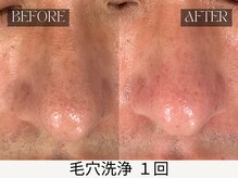 スキンジム(SKIN GYM)/毛穴洗浄 施術効果