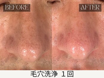スキンジム(SKIN GYM)/毛穴洗浄 施術効果