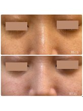 【医療提携】毛穴・たるみ・美肌育成専門店　緒々one＋【チョチョワンプラス】/月１度のフェイシャルで美肌管理