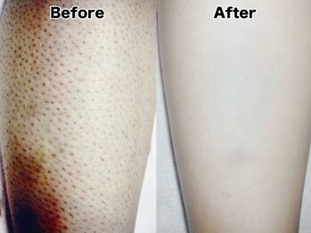 オーシャンブルー 佐世保店(OCEAN BLUE)/結果の出る脱毛【ひざ下】