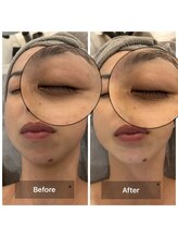 ルミエール(Lumiere)/４０代女性　クマ改善