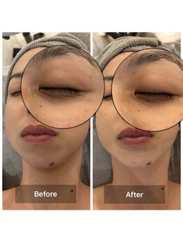 ルミエール(Lumiere)/４０代女性　クマ改善