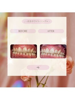 プラスビーセルフ(+b self)/ホワイトニングビフォーアフター