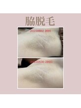 エステティック レイビス 新宿店(RAYVIS)/ワキ脱毛