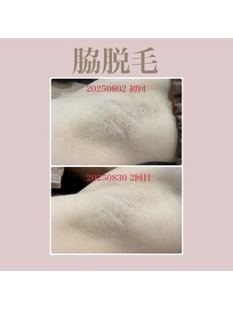 エステティック レイビス 新宿店(RAYVIS)/ワキ脱毛