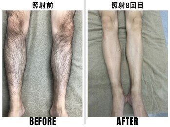 ストック 立花店(STOCK)/【全身】ひざ下照射前→8回目