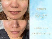 ライフサロン 天神(Life Salon)の雰囲気（エステ版オンダマシン【エルテオンリフト】Before /After）