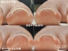 ニコプラス(NICO+)/巻き爪ケア