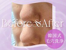 フォトギャラに韓国式毛穴洗浄のBefore⇒After多数掲載中◎