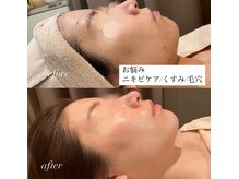 ウー バイ ルーヴェ(ou by Luve)/陶肌トリートメント