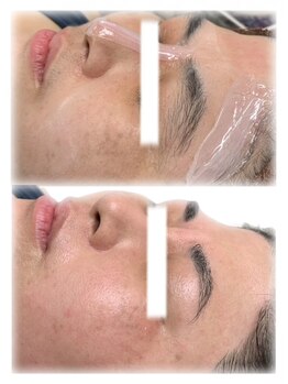 ブリリアンス(BRILLIANCE)/WAX後は肌別パックで美肌ケア↑