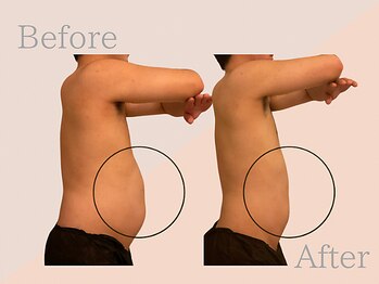 ファミーユ 名古屋店/【メンズ痩身ケア】お腹周り痩身