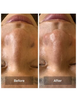 フェイシャルサロン ミギー(Miggie)/メンズ毛穴洗浄　人気急上昇