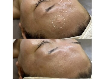 リフテグレース(LIFTE Grace)/エクソソームハーブピーリング