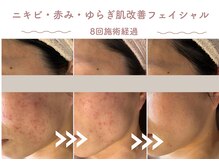 エステティックサロン シーズ/繰り返す肌荒れ改善