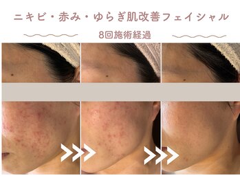 エステティックサロン シーズ/繰り返す肌荒れ改善