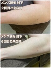ゼロ(ZERO)/足/腕脱毛☆before&after