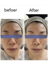 リッチベル(richbelle)/ハーブピーリングモニター様