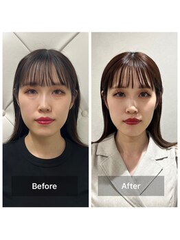 ヴィーライン 恵比寿本院(VeLine)/お客様Before After/小顔効果