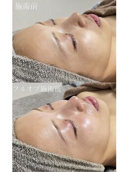 クレヴィー(Creviy)/陶肌トリートメントフルオプ