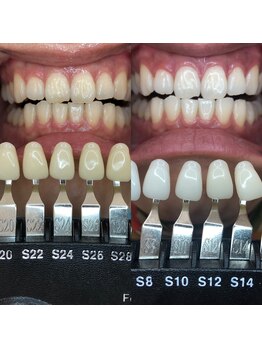トウキョースワーズ 渋谷店(TOKYO SWRS)/#ホワイトニング #渋谷 #池袋