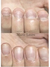 マリーロール 天王寺店(Marie Laure)/自爪育成/深爪矯正/ネイルケア