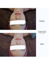 ココセンガビューティークリニック 恵比寿(COCO SENGA Beauty-Clinic)/【COCO JET】ヒアルロン酸導入