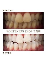 ホワイトニングショップ 千葉店/歯科提携　ホワイトニング専門店
