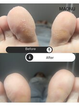 マオヌー(MAONU)/韓国式足裏角質ケア　症例写真
