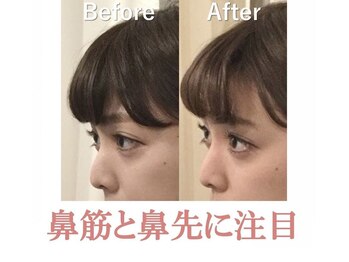 ラプリボーテ(Raplit BEAUTE)/隆鼻＋輪郭矯正40分10回