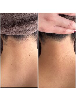 サロン ヴィラ(villa)/#うなじ脱毛#脱毛