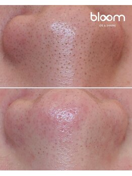 ブルーム 四条烏丸(bloom)/毛穴洗浄