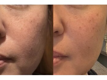 じぶんniプラス/常滑/フェイシャル/シミ/たるみ