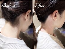 ピミル(PIMIL)/うなじ脱毛