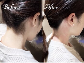 ピミル(PIMIL)/うなじ脱毛