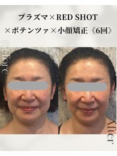ドゥシール(Docile)/50代女性｜小顔・二重あご改善