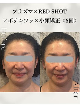 ドゥシール(Docile)/50代女性｜小顔・二重あご改善