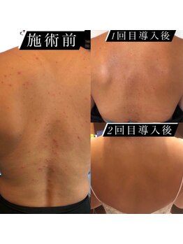 ウィズサロン(withサロン)/背中ニキビケアハーブピーリング