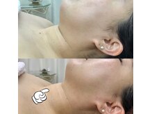 トータルエステサロン エステアンドメイク 錦糸町/リフトアップ、小顔効果◎