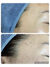 リシア(Re.sia)/シミケアの施術後