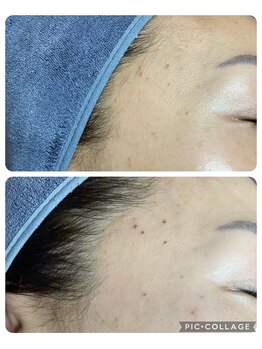 リシア(Re.sia)/シミケアの施術後