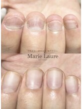 マリーロール 天王寺店(Marie Laure)/自爪育成/深爪矯正/ネイルケア